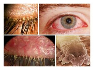 symptômes de la présence de parasites sous la peau humaine